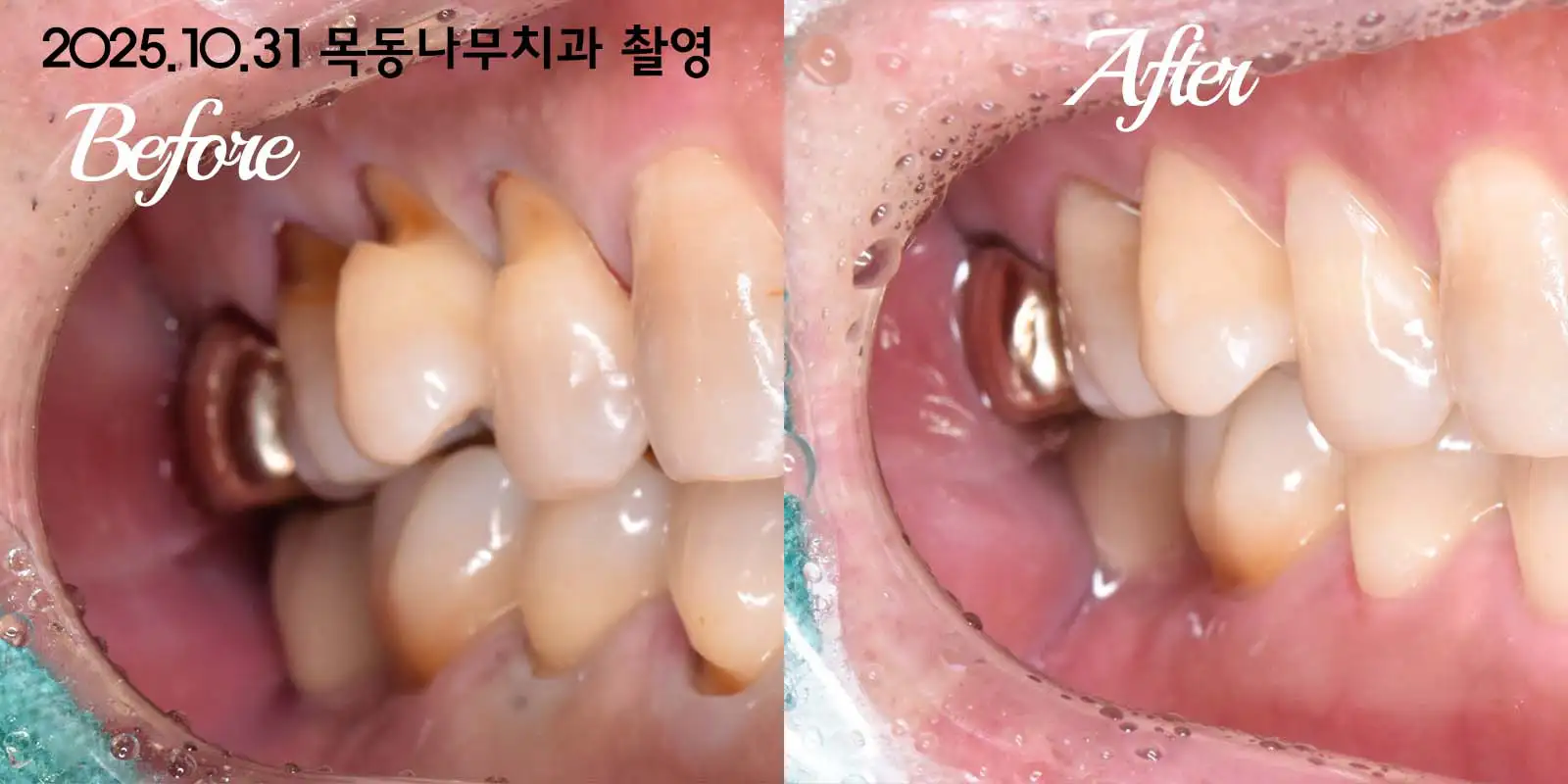 치아 3개 치경부 마모증 레진 치료 사례