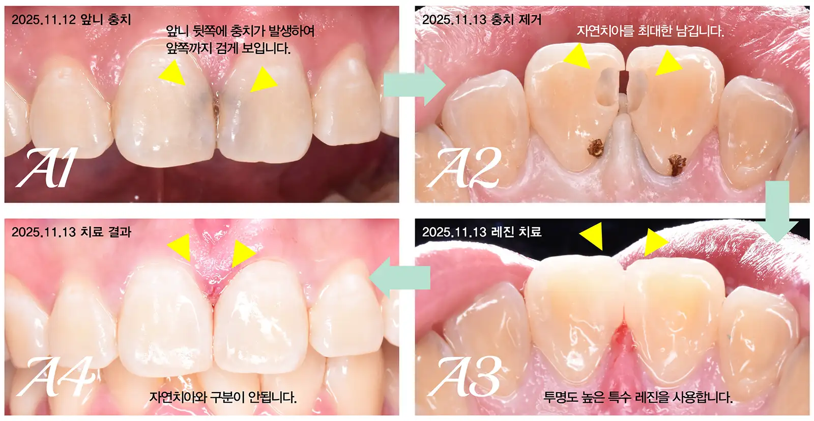 앞니 레진 치료 사례. 뒤쪽에서 접근하여 충치를 제거하여 앞쪽을 최대한 남깁니다.