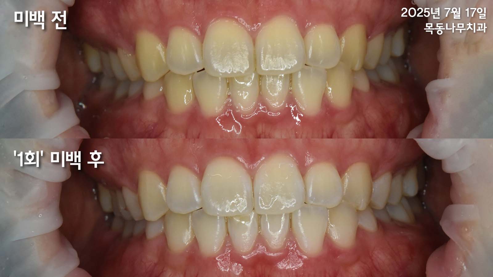 치아 미백 전과 1회 미백 후 비교 사진